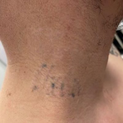 Tattoo removal 7