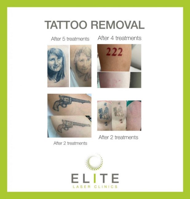 Tattoo removal 2